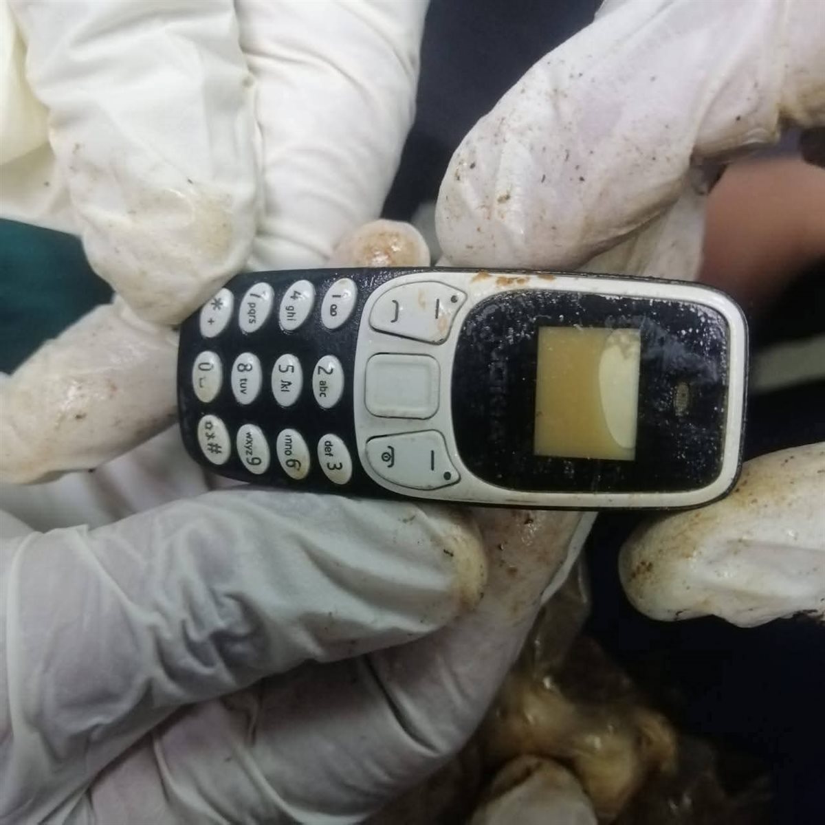التليفون المستخرج من المريض