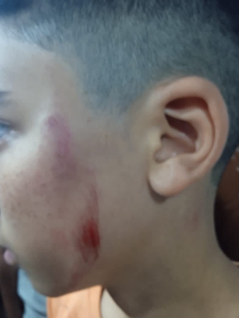 اثار الضرب بوجه الطالب 