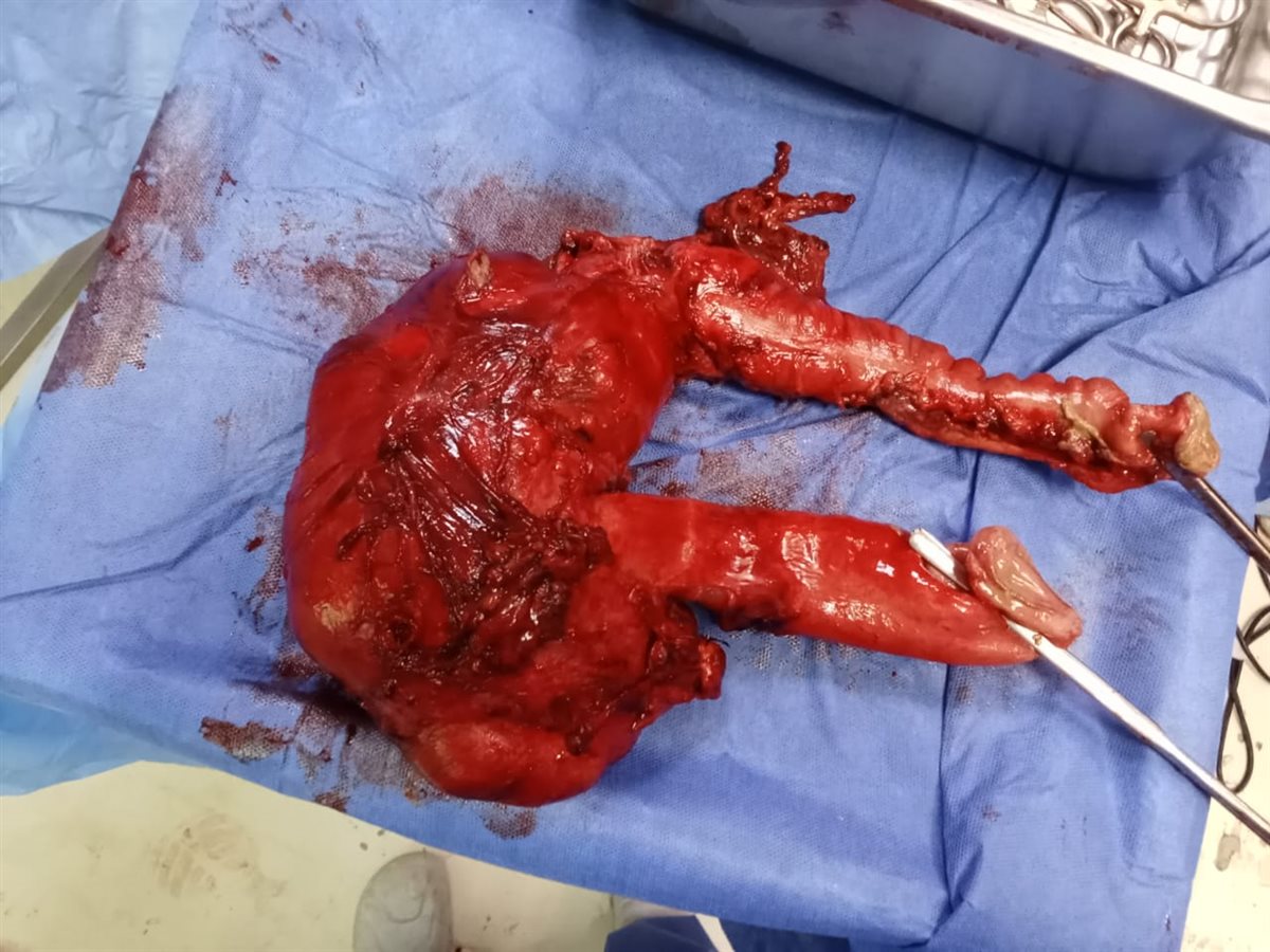 فريق الجراحة بالمستشفى العام يستئصل ورم بالقولون يزن 7 كيلو جرام لمريض