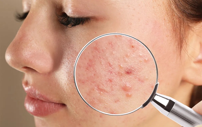 أسباب ظهور حب الشباب