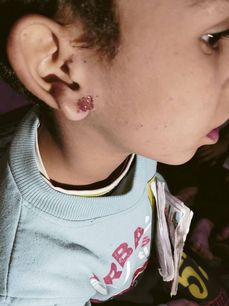 آثار الضرب على وجه الطفل&nbsp;