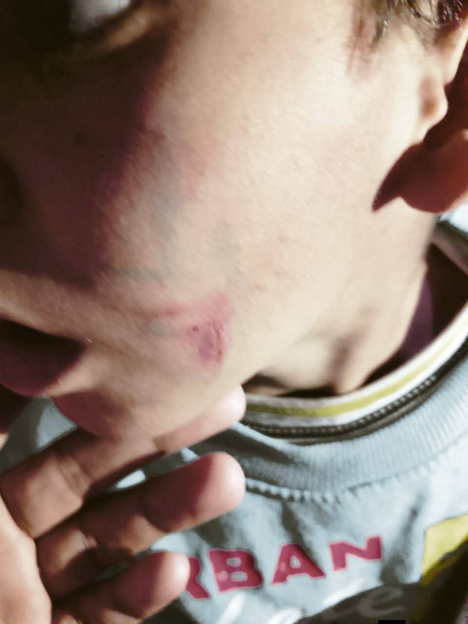 آثار الضرب على وجه الطفل&nbsp;