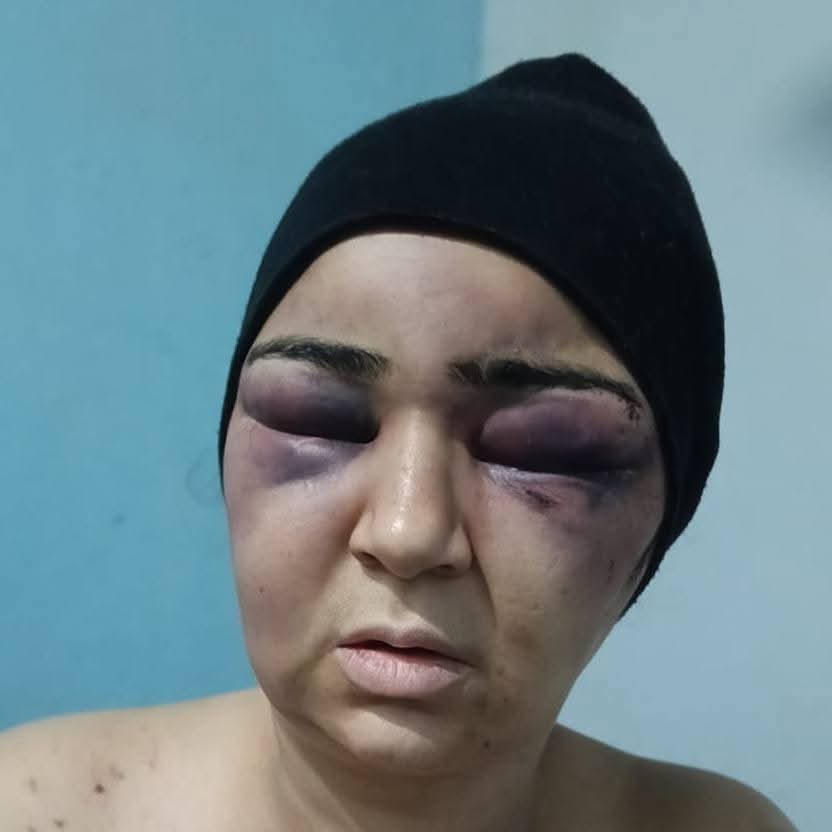 أصابات بالغة بالوجه واليدين… زوج يعتدي بالضرب علي زوجته بالفيوم