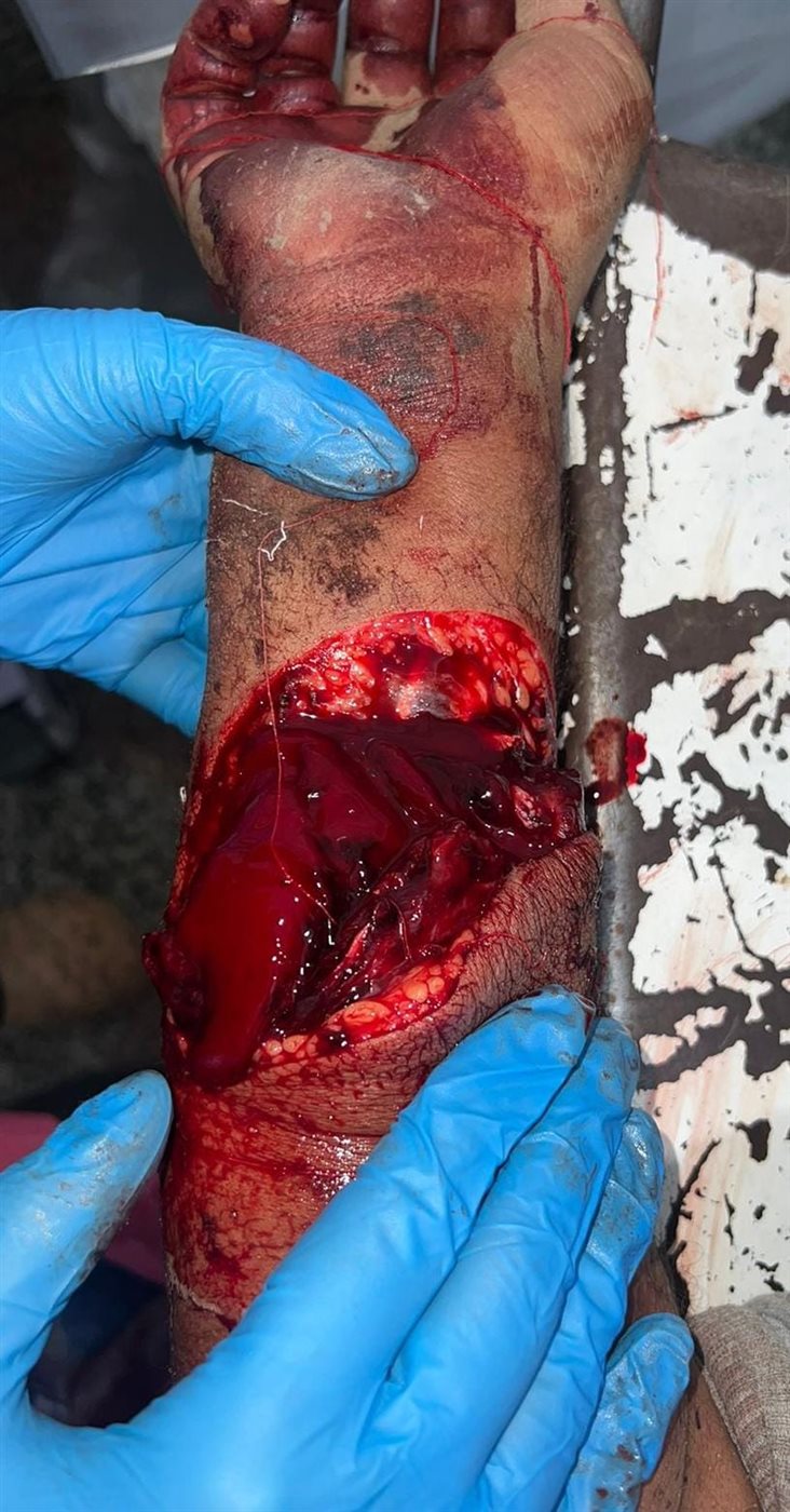 فريق جراحات التجميل بمستشفى الفيوم العام .. ينجح فى أنقاذ شاب من بتر زراعة
