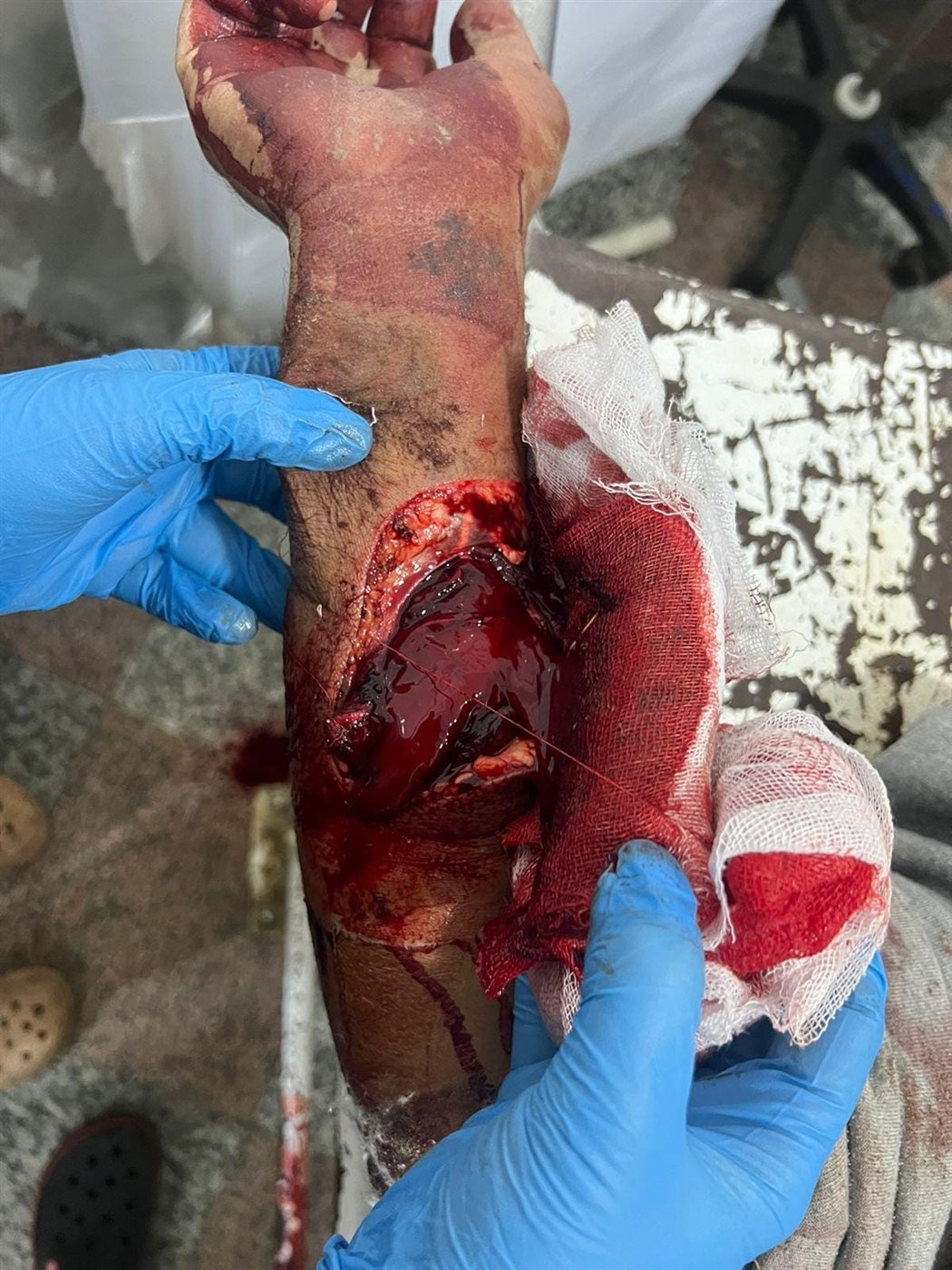 فريق جراحات التجميل بمستشفى الفيوم العام .. ينجح فى أنقاذ شاب من بتر زراعة