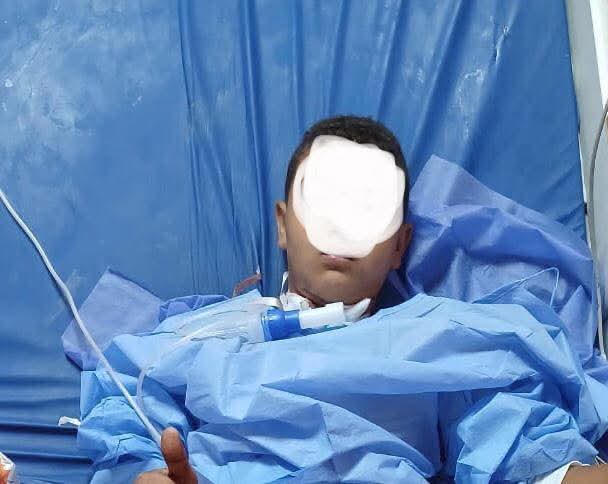 إختراق سيخ حديدى لمنطقة الرقبة وخروجه من الوجه