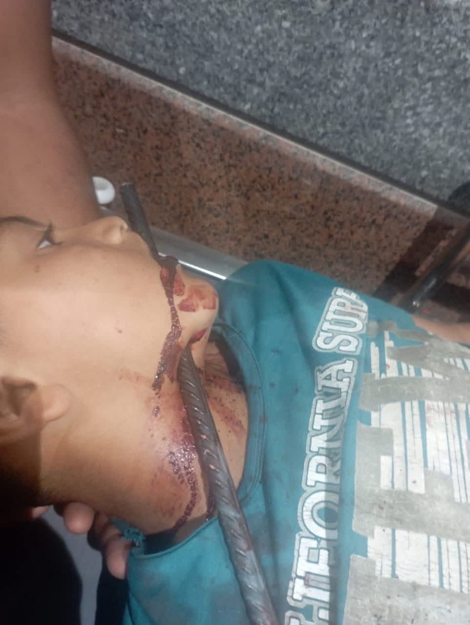 إختراق سيخ حديدى لمنطقة الرقبة وخروجه من الوجه