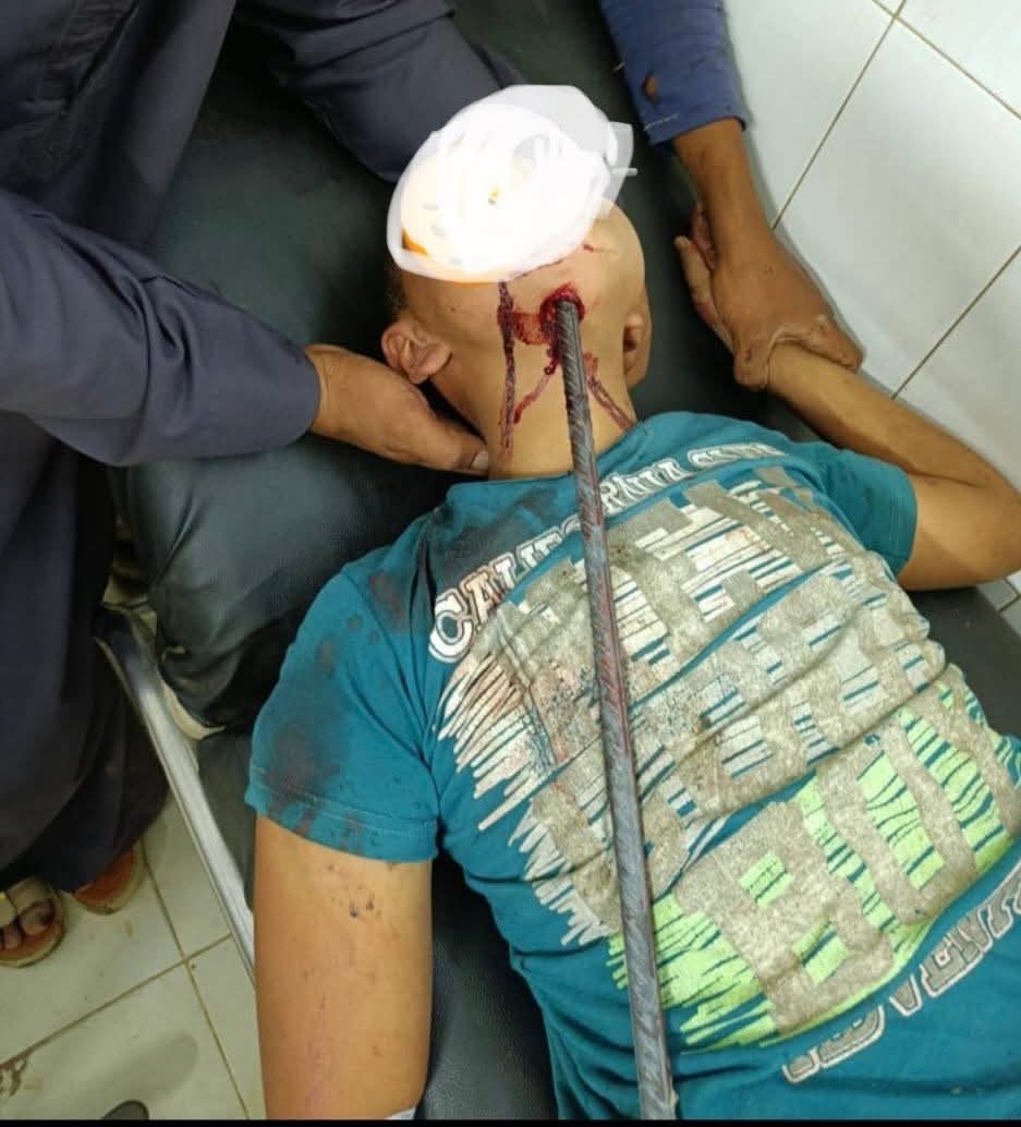 إختراق سيخ حديدى لمنطقة الرقبة وخروجه من الوجه