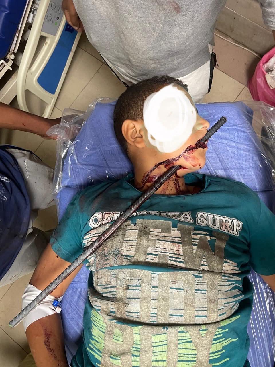 إختراق سيخ حديدى لمنطقة الرقبة وخروجه من الوجه