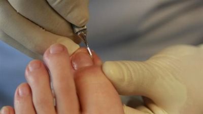 مرض الظفر الغائر.. أهم أسبابه وطرق علاجه بدون جراحة