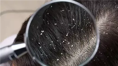 طرق علاج القشرة.. وأبرز الأسباب والأنواع