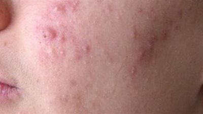 احذري... ماسكات طبيعية منزلية تدمر بشرتك