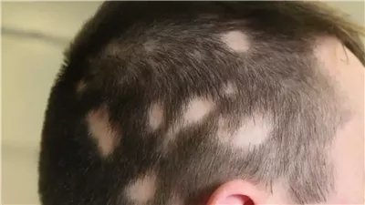 مرض الثعلبة.. الأنواع والأسباب وطرق العلاج 