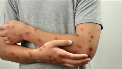 المصل واللقاح : جدري القردة وفياته مرتفعة.. وأعراضه مثل الإنفلونزا