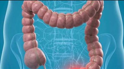 وجبة خفيفة يومية تقلل من خطر الإصابة بسرطان القولون