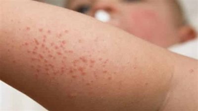 مرض حساسية الجلد.. أسبابه وأعراضه وطريقة علاجه