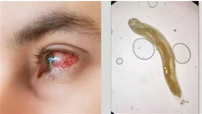 أطباء يزيلون دودة حية من عين رجل.. تعرف على الطريقة التي دخلت بها!