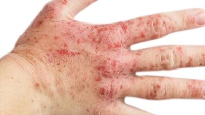 مرض الأكزيما.. أسبابه وأعراضه وتشخيصه وعلاجه