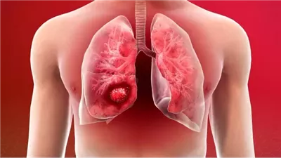 سرطان الرئة.. أسبابه وأعراضه وتشخيصه وعلاجه