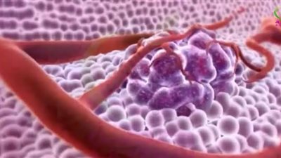 السرطان في الهند.. نسب إصابات ووفيات مرتفعة تثير القلق 