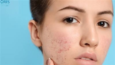 أهم النصائح للتخلص من حب الشباب نهائيًا وإلى الأبد 