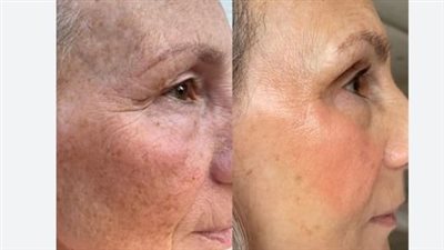 الكولاجين البحري: بديل واعد لمكافحة الشيخوخة ودعم الصحة