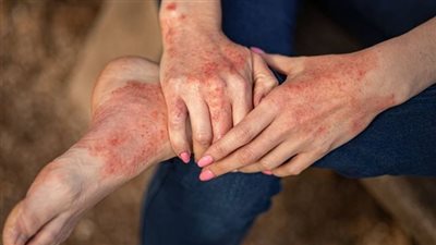 الإكزيما والشتاء.. 8 طرق للوقاية من المرض في الطقس البارد