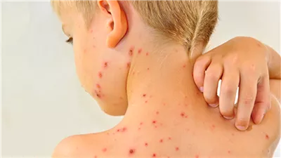 رئيس الرابطة الطبية الأوربية يحذر من أسباب زيادة انتشار الحصبة في أوربا .. وهذا موقف مصر (فيديو)