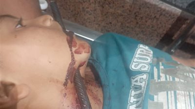 انتصر الأمل على الحديد.. جراحة دقيقة تنقذ طفلًا اخترق سيخ رقبته وفكه بسوهاج