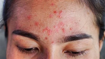 أخصائية تجميل تحدد 5 خطوات للوقاية من فطريات الصيف |خاص