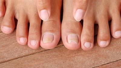 أظافر القدم قد تكشف عن أمراض خطيرة.. لا تهمل هذه العلامات