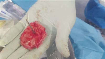 إنجازطبي بمستشفي جامعة الفيوم.. استخراج «مسمار» من جمجمة طفل دون مضاعفات