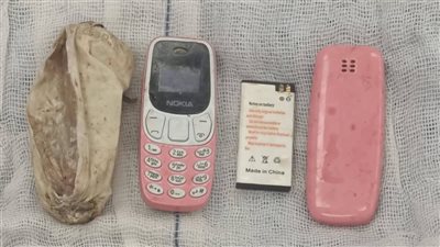 استخراج هاتف محمول من معدة مريض في عملية نادرة بمستشفى ناصر التخصصي