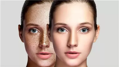 في اليوم العالمي لتصبغ الجلد.. حلول طبيعية للتغلب عليه خلال الصيف