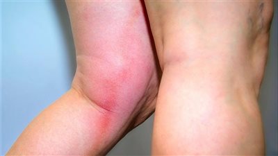 أعراض جلطة الساق.. احذر من هذه العلامات الخمس المبكرة