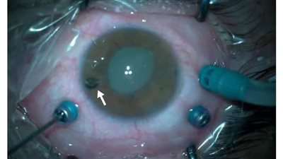 خلال أسبوع.. فريق طبي بجامعة كفر الشيخ ينقذ 3 أشخاص من فقدان البصر