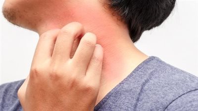 أسباب الحكة في الجسم.. أنواعها ومتى تستدعي العلاج العاجل