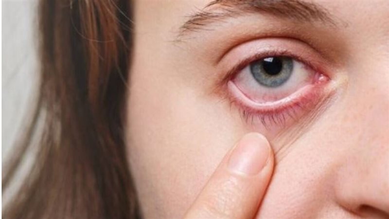 أعراض حساسية العين