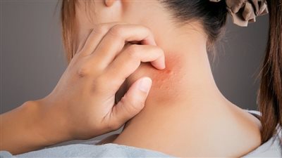 سرطان الجلد.. منطقة صغيرة على الجسم أكثر عرضة لخطر المرض القاتل