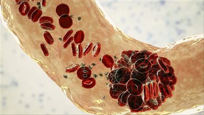 عادة صيفية شائعة قد ترفع خطر الإصابة بـ الجلطات الدموية