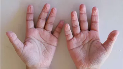 السبب الحقيقي وراء تجعد الأصابع بعد الاستحمام أو السباحة