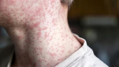 ارتفاع حاد في إصابات الحصبة بالولايات المتحدة عام 2025