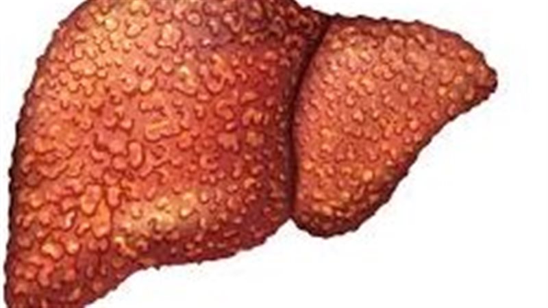  تلف الكبد الناتج