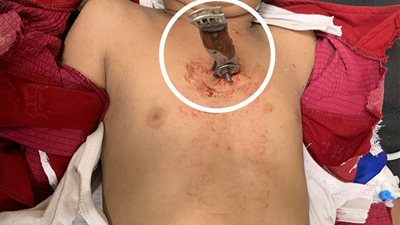 مستشفيات سوهاج الجامعية تنجح في إنقاذ طفل تعرص لطعنة نافذة بالقلب