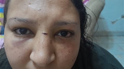 «فقدت عينها».. أم تستغيث: حق بنتي راح بين الإهمال والتهديد