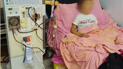 «الأطباء»تكشف عن تفاصيل إنقاذ طفل مريض بالفشل الكلوي و