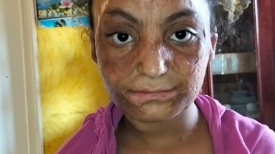 5 سنوات من الألم.. طفلة تحارب آثار الحروق والتنمر في الفيوم