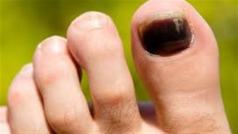 أعراض سرطان الأظافر