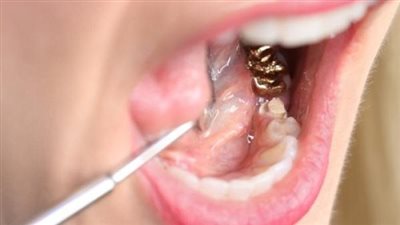 ما حكم عمل حشو الأسنان بالذهب؟ اللإتاء توضح الحكم 