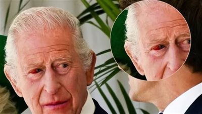 بقعة حمراء في عين الملك تشارلز.. عَرض مؤقت أم مؤشر خطير؟